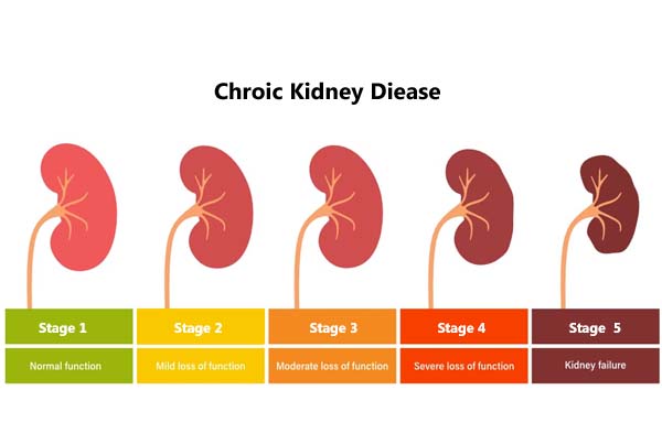 Chronic Kidney Failure