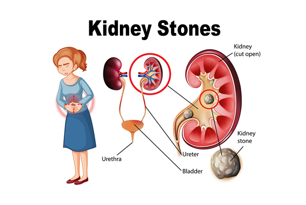 Kidney Stone